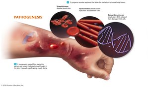 Pathogenesis of necrotizing fasciitis showing tissue invasion and destruction