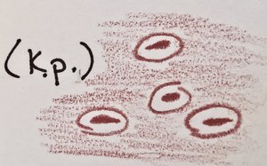 Microscopic appearance of Klebsiella pneumoniae with capsule halo