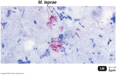 Acid-fast staining of Mycobacterium leprae