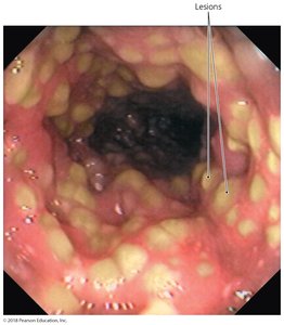 Pseudomembranous colitis