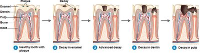 Process of tooth decay
