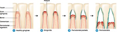 Stages of periodontal disease