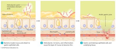 Role of Helicobacter pylori in peptic ulcers