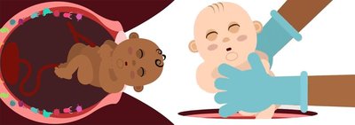 Illustration of birth and newborn colonization