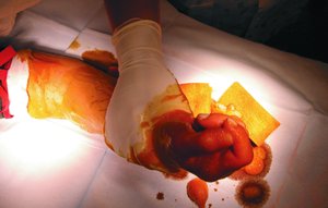 Degerming in preparation for surgery on a hand