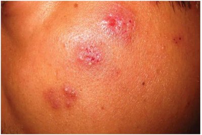 Oral herpes lesion on the lip