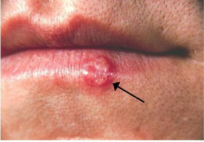 Genital herpes lesions