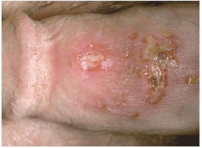 Neonatal herpes (face blurred)