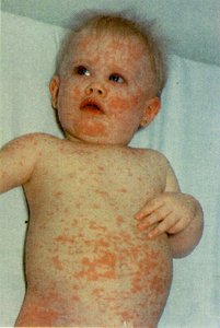 Measles rash on trunk