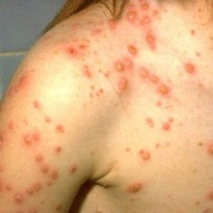 Varicella zoster pathogenesis diagram