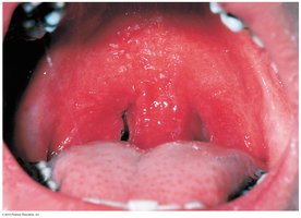 Streptococcal pharyngitis