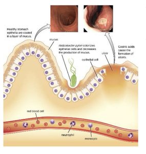 Helicobacter pylori colonization and ulcer formation in the stomach