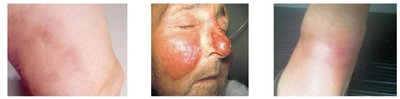 Skin manifestations of Streptococcus pyogenes infections