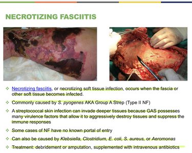 Necrotizing fasciitis clinical presentation and treatment