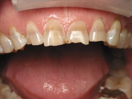 Tetracycline-induced tooth damage
