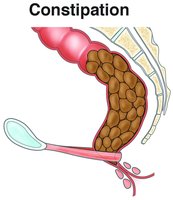 Diagram of constipation in the colon