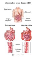 Diagram of inflammatory bowel disease (IBD)