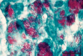 Acid-fast Mycobacterium tuberculosis