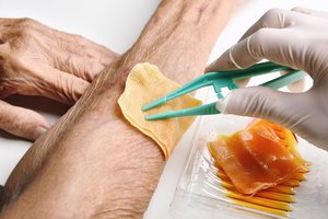 Medical-grade honey being applied to a wound