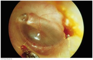 Bulging eardrum in acute otitis media