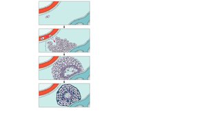 Pathogenesis of tuberculosis: tubercle formation