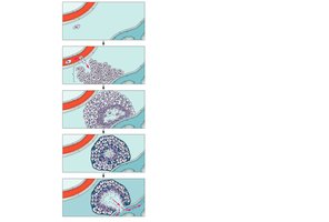Pathogenesis of tuberculosis: tubercle rupture and dissemination