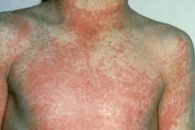 Scarlet fever rash