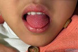 Strawberry tongue in scarlet fever
