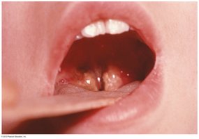 Diphtheria membrane on tonsils
