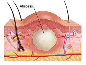 Abscess diagram