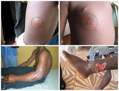 Clinical images of Buruli ulcer progression