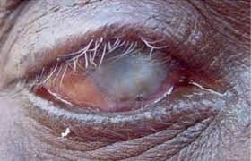 Eye affected by trachoma