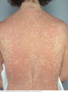Penicillin rash on the back