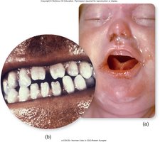 Congenital syphilis: Hutchinson's teeth and infant with symptoms