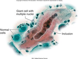 Giant cell with multiple nuclei in herpes infection