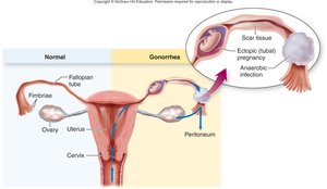 Gonorrhea and its complications in the female reproductive tract