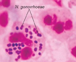 Microscopic image of Neisseria gonorrhoeae