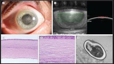 Microsporidia infection in the eye