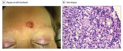 Cutaneous Cryptococcus infection