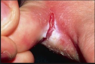 Athlete's foot, a cutaneous mycosis