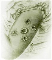 Smallpox lesions on arm