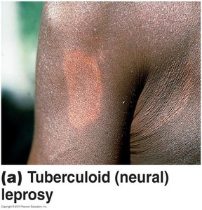 Tuberculoid leprosy lesion