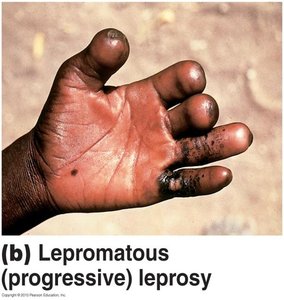 Lepromatous leprosy with hand deformities