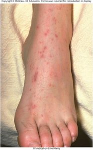 Petechiae on the skin, a symptom of meningococcal meningitis