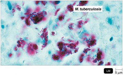 Acid-fast stain of Mycobacterium tuberculosis
