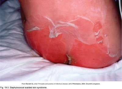 Staphylococcal scalded skin syndrome