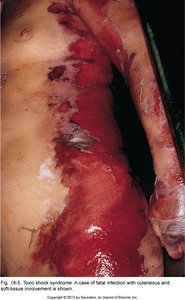 Toxic shock syndrome with cutaneous and soft-tissue involvement