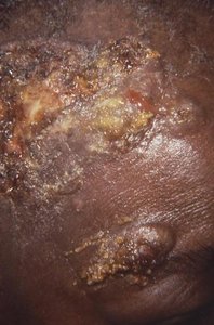 Streptococcal impetigo