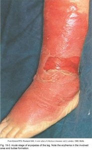 Erysipelas of the leg