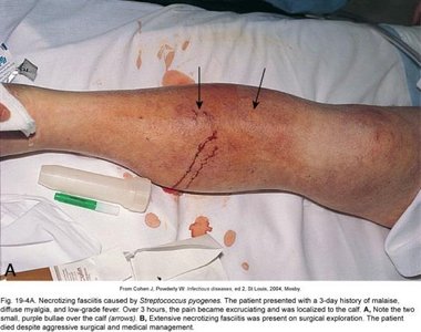 Necrotizing fasciitis, early stage